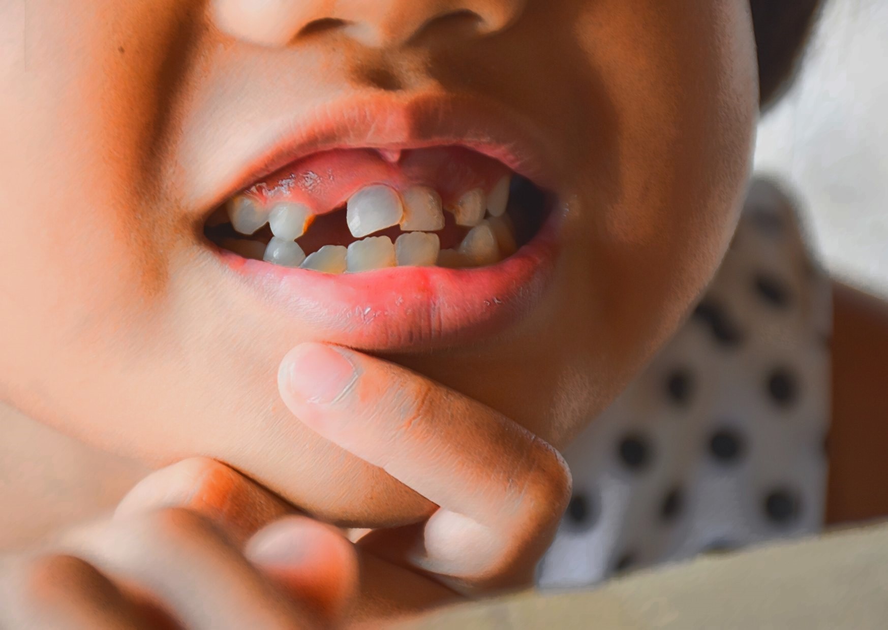 Impacto - Cor e Forma Interna de Dentes Anteriores (Edição